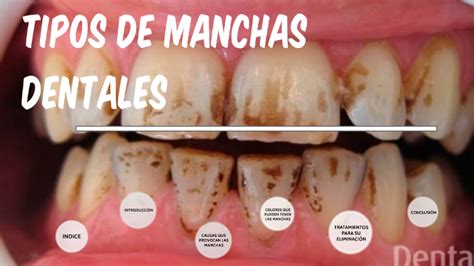 Tipos de manchas dentales