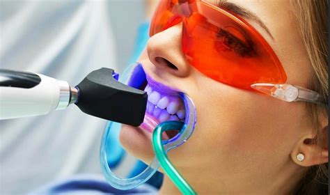 Procedimiento de blanqueamiento dental en clínica