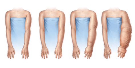 Representación del linfedema en el brazo