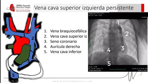 Esquema de la vena cava superior izquierda persistente