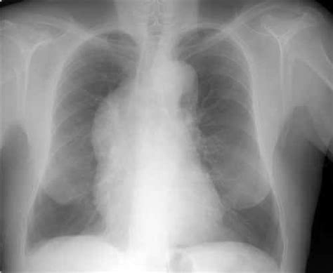 Radiografía de tórax mostrando ensanchamiento mediastínico