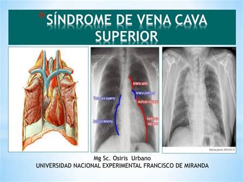 Ilustración de los síntomas del síndrome de la vena cava superior
