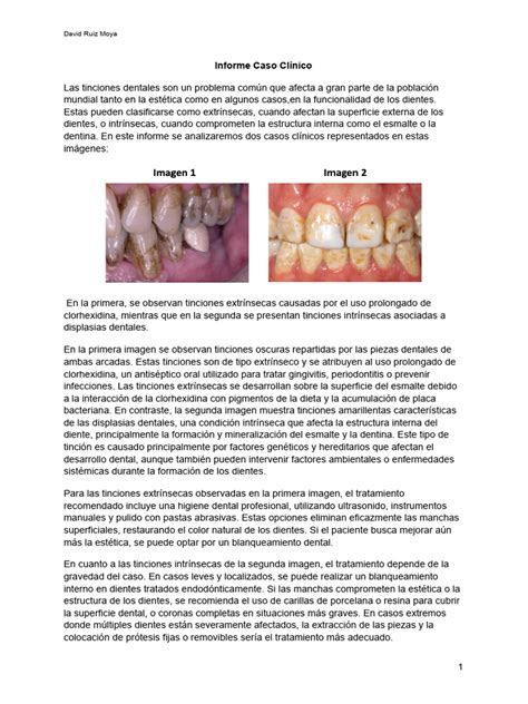 Ilustración mostrando causas extrínsecas e intrínsecas de la discromía dental