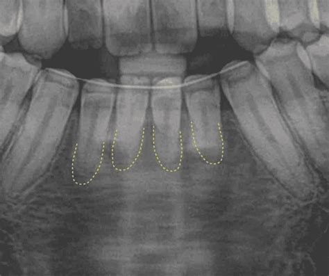 Radiografía dental mostrando posible reabsorción cervical