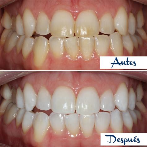 Comparación visual de dientes antes y después del blanqueamiento dental