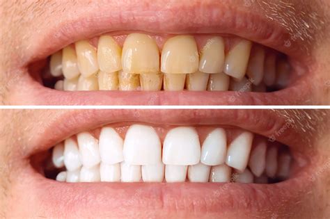 Comparación de color dental antes y después del blanqueamiento