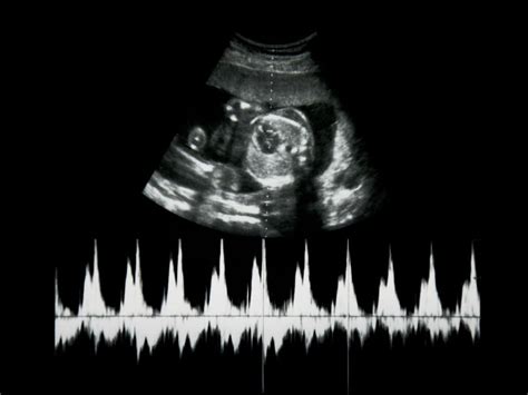Ecografía mostrando ausencia de latido cardíaco fetal
