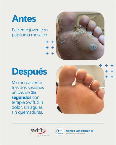 Infografía sobre la prevención de verrugas plantares