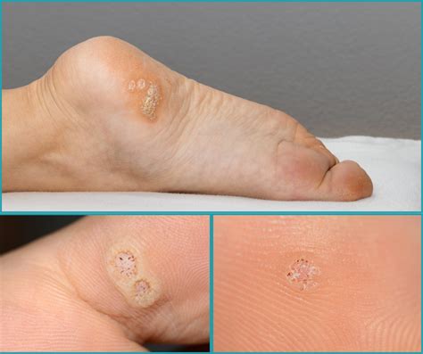 Imagen comparativa de diferentes tratamientos para verrugas plantares