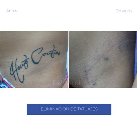 Gráfico de Sesiones de Eliminación de Tatuajes por Tipo de Tinta