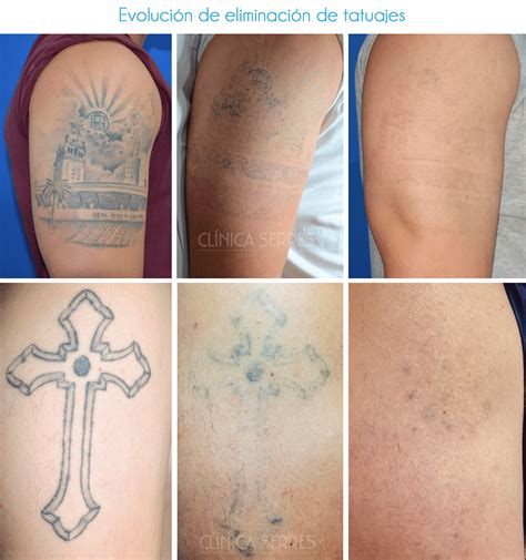 Comparativa de Tatuajes Antes y Después de la Eliminación con Láser