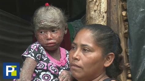Niña Bonney con la enfermedad de las escamas de zafiro