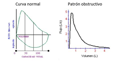 Gráfico de espirometría con curva flujo-volumen normal y patológica