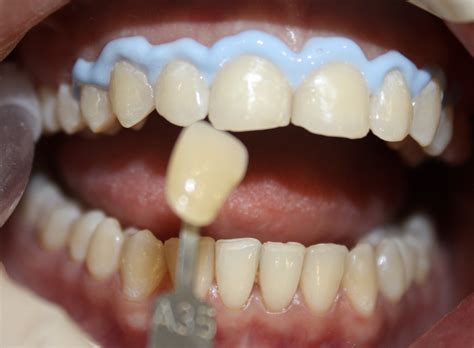 Gráfico comparativo de concentraciones de blanqueamiento dental