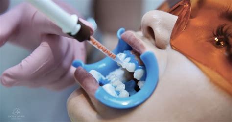 Proceso de blanqueamiento dental en clínica