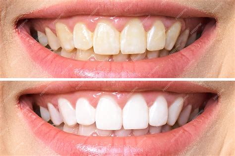 Comparativa de color de dientes antes y después del blanqueamiento