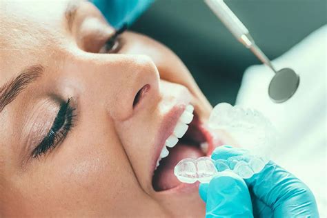 Infografía sobre cómo funciona el blanqueamiento dental