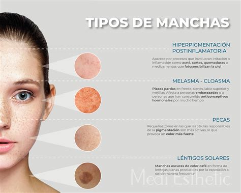 Tipos de manchas en la piel