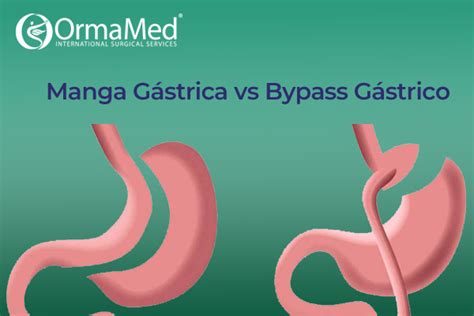 Infografía comparativa de manga gástrica y bypass gástrico