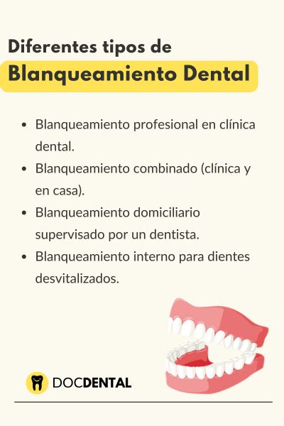 Infografía: Comparativa de tipos de blanqueamiento dental