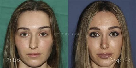 Comparativa de imágenes de Paula Gonu antes y después de posibles procedimientos estéticos