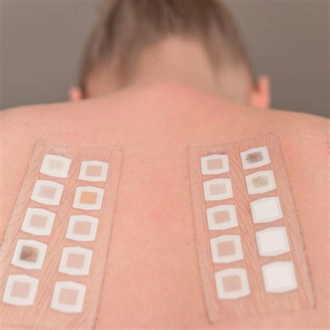 Imagen de una prueba de parche en la piel