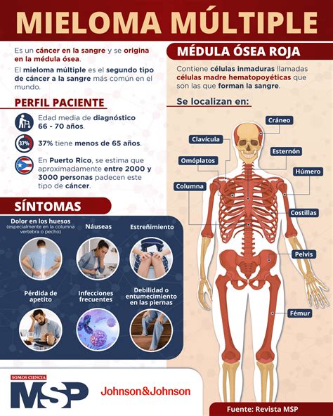 Infografía sobre el Mieloma Múltiple