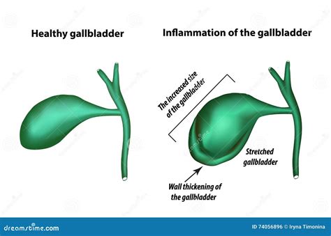 Representación de la inflamación de la vesícula biliar