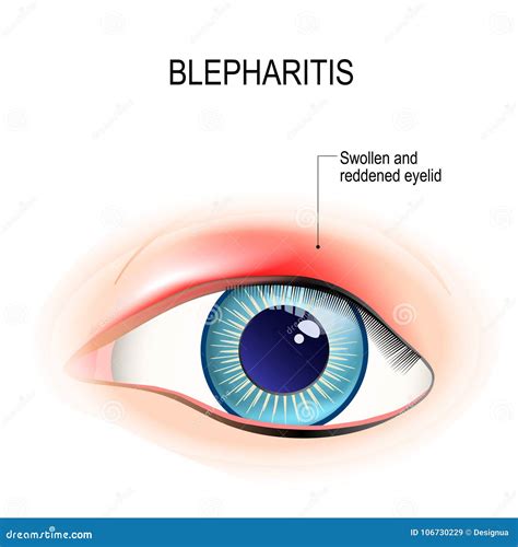 Anatomía del ojo y párpado con blefaritis