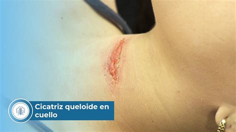 Retrato de Ban mostrando su cicatriz característica en el cuello.