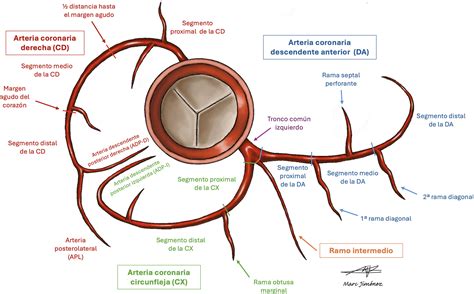 Representación esquemática de la inflamación en las arterias coronarias en la enfermedad de Kawasaki