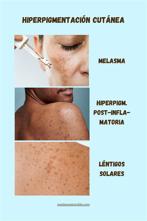 Ejemplos de hiperpigmentación facial (melasma, manchas solares, hiperpigmentación postinflamatoria)