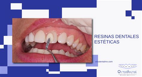 Infografía comparativa de tratamientos dentales estéticos