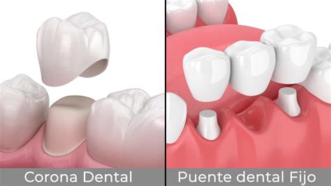 Diferencias entre corona atornillada y corona a presión