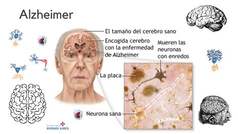 Infografía sobre la prevalencia del Alzheimer y la demencia en personas mayores