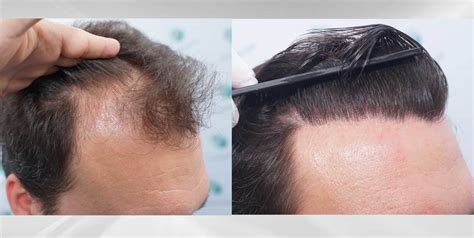 Técnica de miniaturización en un cabello humano