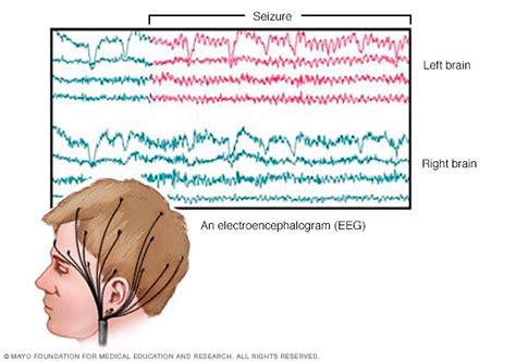 Esquema de un electroencefalograma (EEG) mostrando actividad típica de ausencia