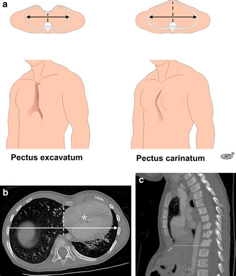 Diagrama del Pectus Excavatum