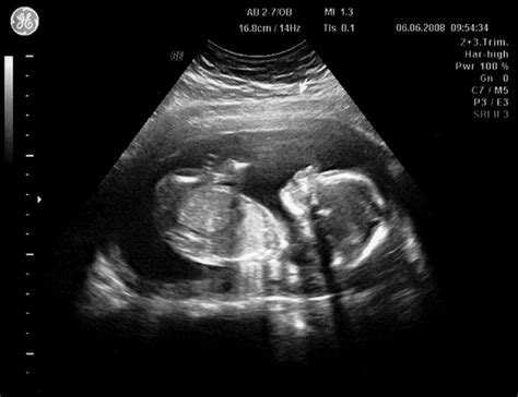 Ecografía de un bebé en desarrollo