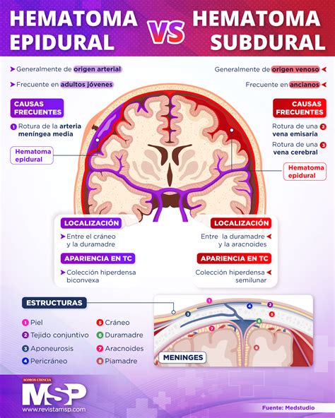 Infografía sobre el hematoma subdural