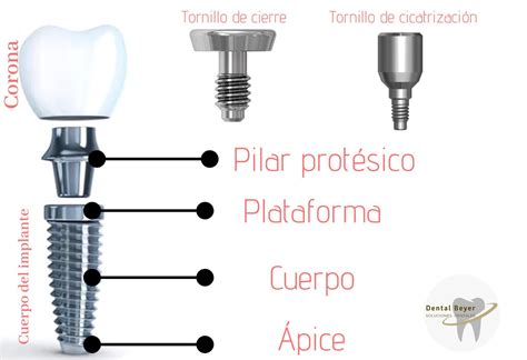 Diagrama de implante dental