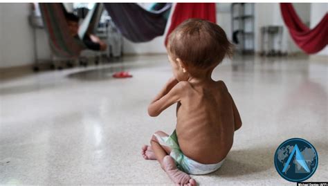 niños con desnutrición