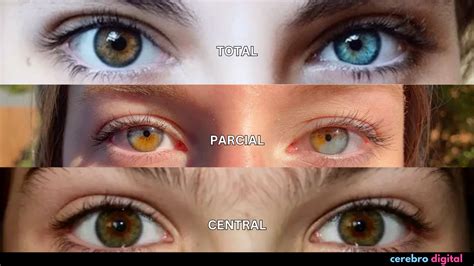 Daisuke con heterocromía