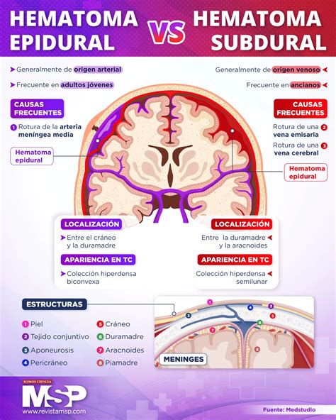 Diagrama del cerebro mostrando la ubicación de un hematoma subdural