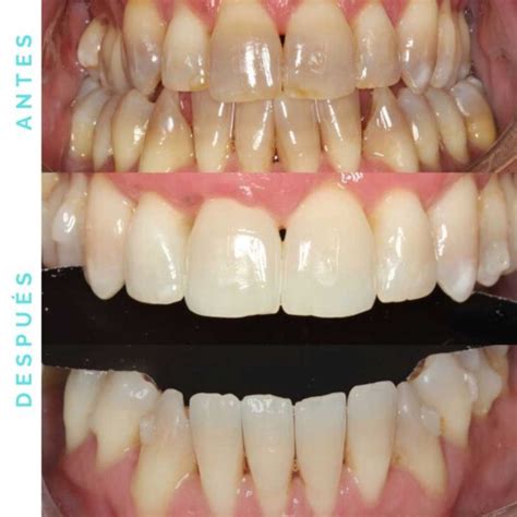 Diagrama del proceso de blanqueamiento dental