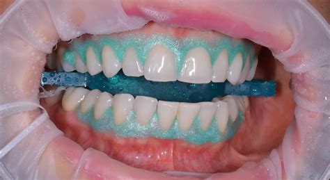 Proceso de blanqueamiento de plástico con luz solar