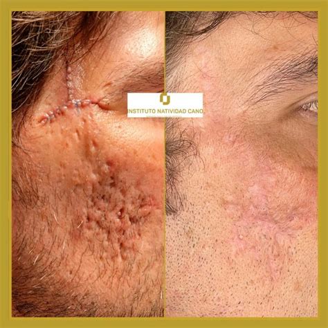 Rostro de Barbablanca con cicatrices de batalla