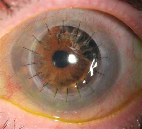 Representación del trasplante de ojos