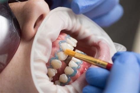 Diagrama del proceso de blanqueamiento dental Zoom