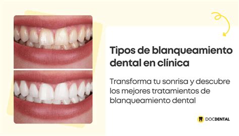 Infografía sobre los tipos de productos de blanqueamiento dental para hombres